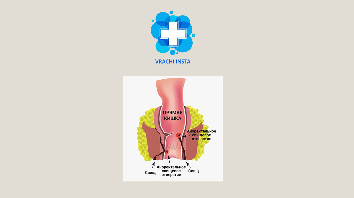  Основные симптомы свища заднего прохода и когда следует обратиться к врачу.

Свищ заднего прохода – это патологическое сообщение между кожей вокруг ануса и прямой кишкой.