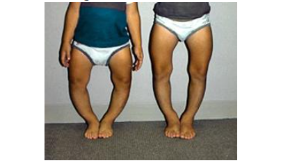 Courtesy of William Phillips, MD. Graphic 66400 Version 1.0