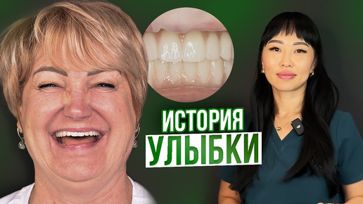 ИСТОРИЯ НЕВЕРОЯТНОЙ УЛЫБКИ! / отзыв пациента, All-On-4