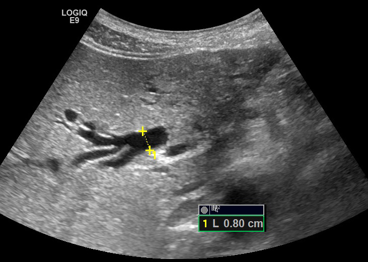 Расширение протоков