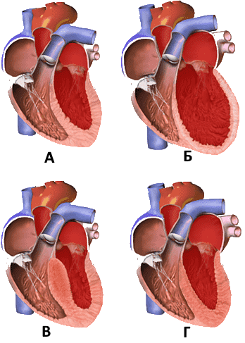 А - нормальное сердце. Б - дилатационная кардимиопатия. В - гипертоническая болезнь. Г - рестрективная кардимиопатия