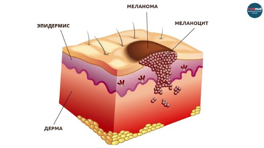 Как выглядит МЕЛАНОМА. Признаки и симптомы меланомы. Как определить рак кожи