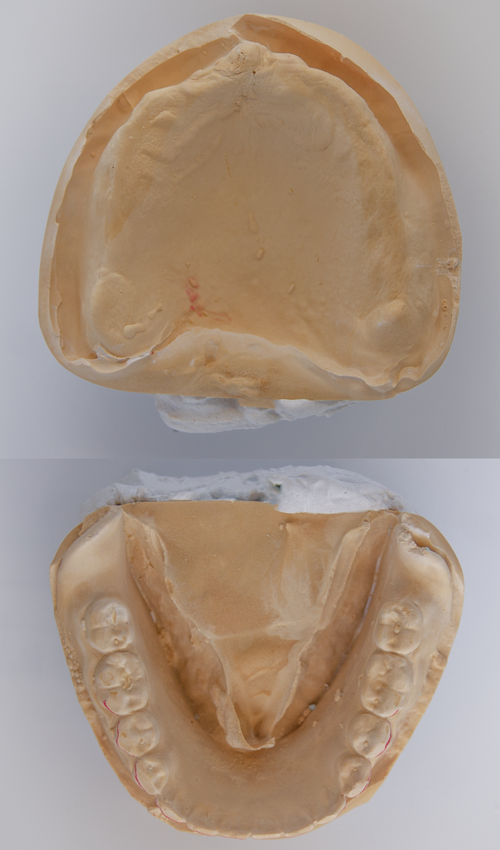 Гипсовые модели полости рта пациента.