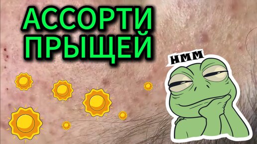 Девушка развела у себя на лице огромный ассортимент прыщей. Косметолог в недоумении с чего начать выдавливать