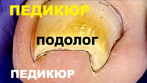 Здесь очень глубоко вросший ноготь.. Маникюр. Салон Красоты.【Педикюр】