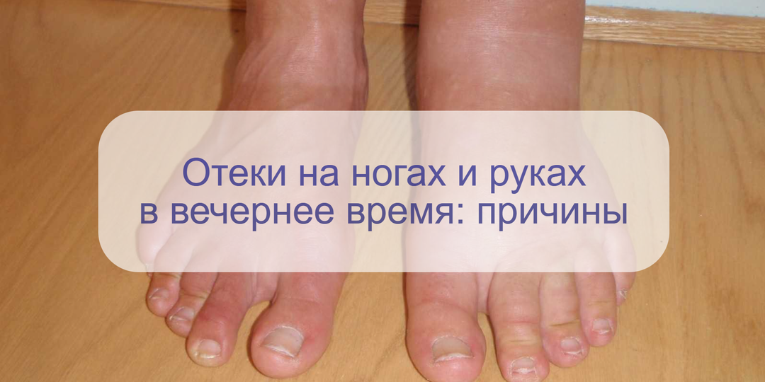 Почему к вечеру отекают ноги и руки? Как убрать отечность и не навредить