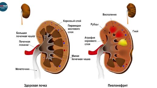 Пиелонефрит: причины и симптомы пиелонефрита. Острый и хронический пиелонефрит почек