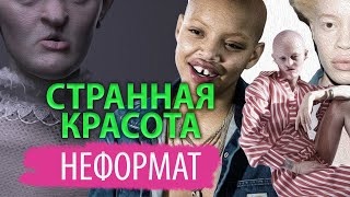 Дефект или изюминка? Девушки, которые добились успеха, несмотря на свою нетипичную внешность