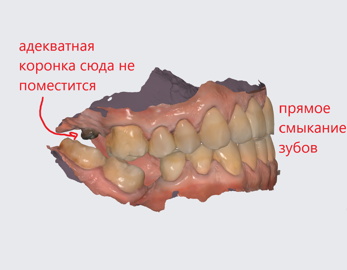 Цифровой слепок челюстей