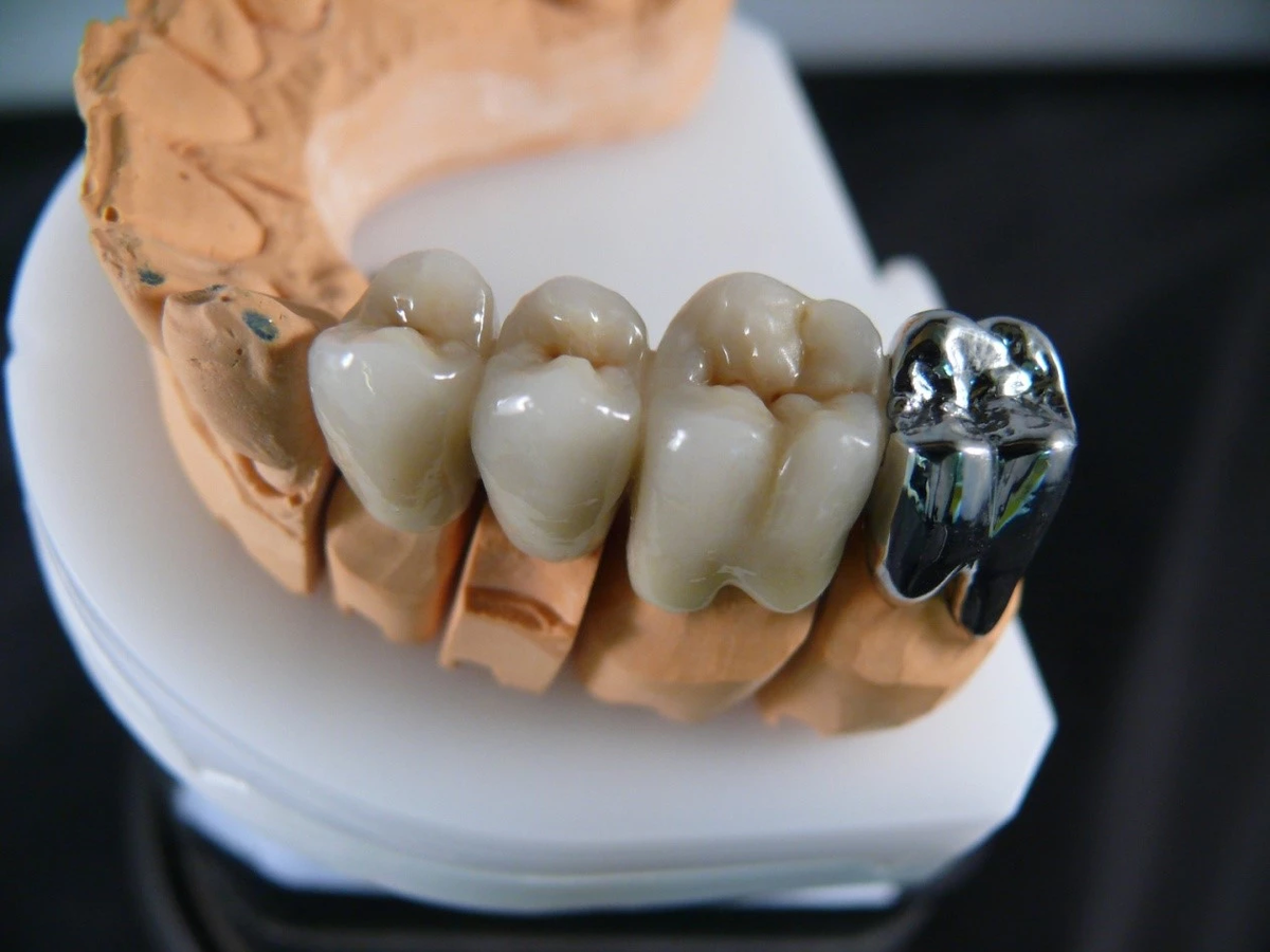 Чтобы точно выяснить причину, нужно показаться стоматологу. Возможно, дело в недостаточной гигиене, а возможно — в разрушении зуба под коронкой или воспалении десны рядом с ней.