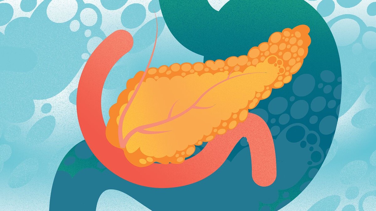Советы гастроэнтеролога по профилактике хронического панкреатита