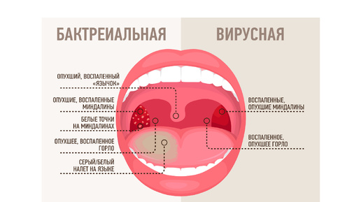 Первые симптомы ангины. Острый тонзиллит у детей и взрослых. Как выглядит ангина