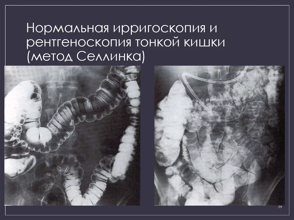 Опухоль толстой кишки рентген. Рентген толстого кишечника с барием. Ирригоскопия толстого кишечника рентген. Снимок ирригоскопии кишечника. Ирригоскопия опухоль сигмовидной кишки.