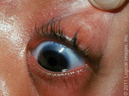 Reproduced with permission from: www.visualdx.com. Copyright VisualDx. All rights reserved.