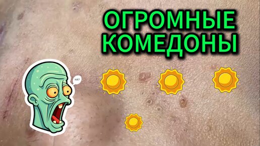 Выдавливание мегакомедонов, после которых остаются огромные воронки. Косметолог явно получает от этого большое удовольствие