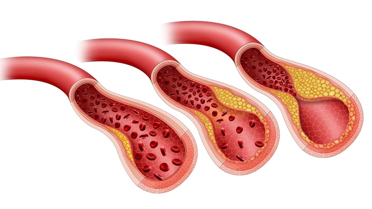 Атеросклероз сосудов: симптомы, виды и причины. Диагностика и лечение  атеросклероза — объясняет врач | Клиника доктора Шурова | Дзен