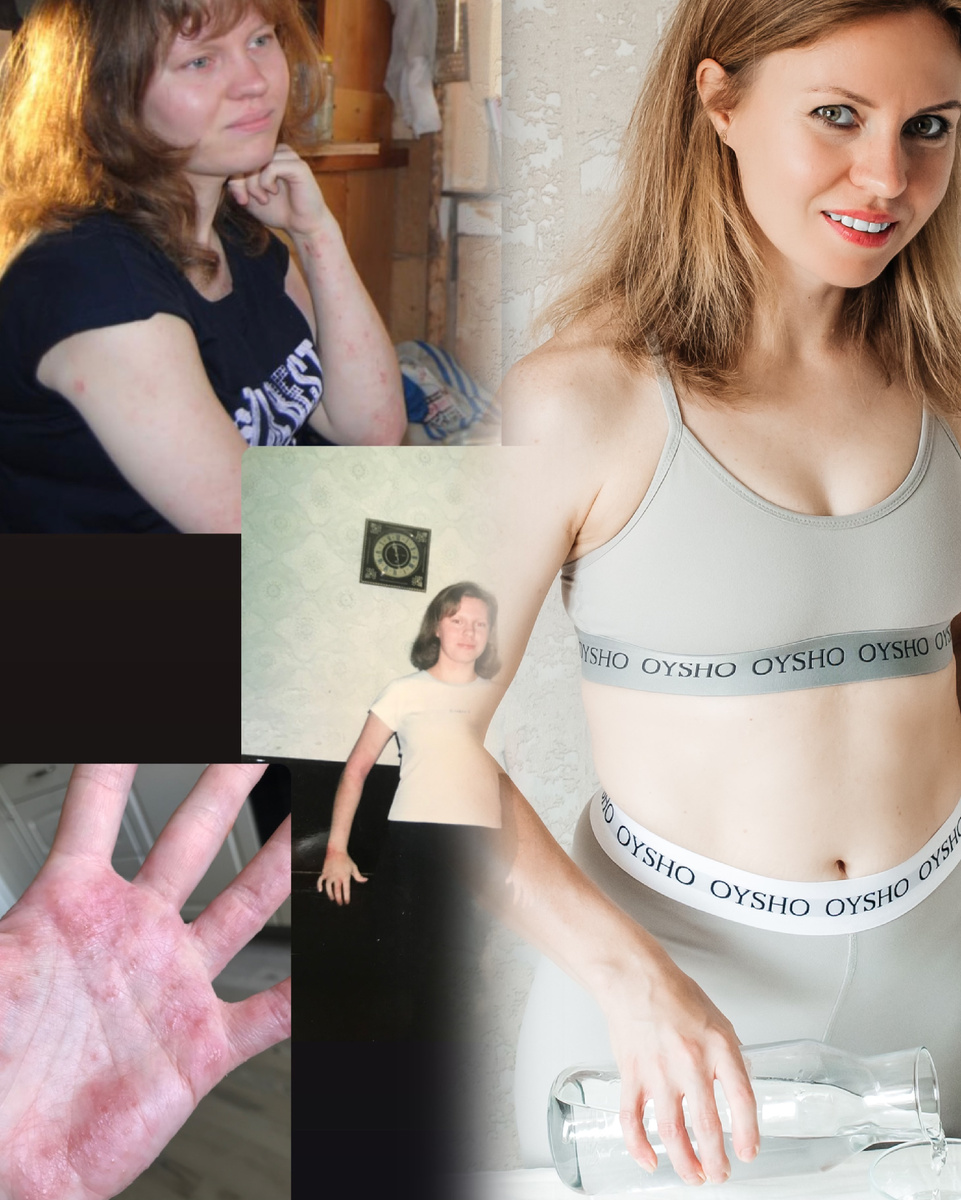 Начиная с 3-х месяцев от рождения и до 29-ти лет меня преследовало заболевание-экзема кожи в тяжелой форме. В 15 лет экземой было покрыто 90% моего тела, она проедала кожу чуть ли не до костей😣об этом даже страшно вспоминать😣к 18-ти годам всё немного стихло, но ненадолго. В 23 года всё снова обострилось, я ходила летом в длинных штанах, водолазке и перчатках и это было ужасно😑