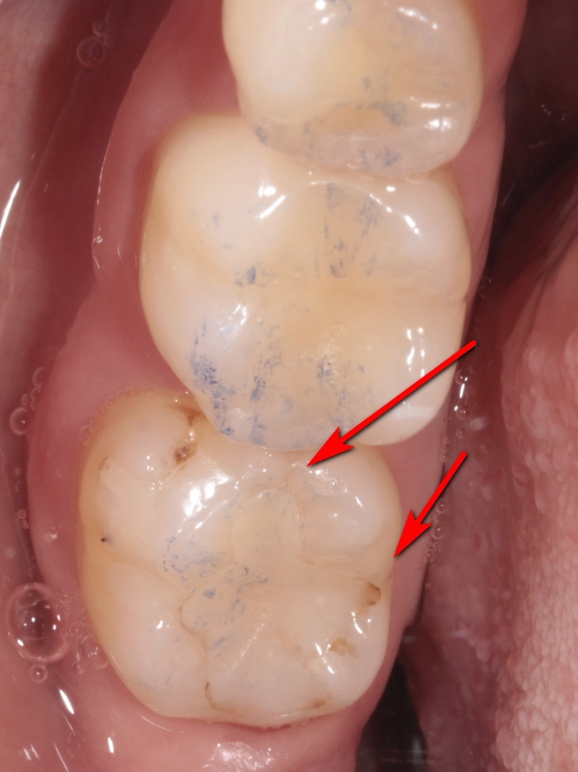 Красными стрелками обозначены трещины на зубе, пломба прокрашена по всей границе, синие точки-следы от копирки, которой проверяли окклюзию (смыкание зубов) до снятия пломбы и обточки зуба 