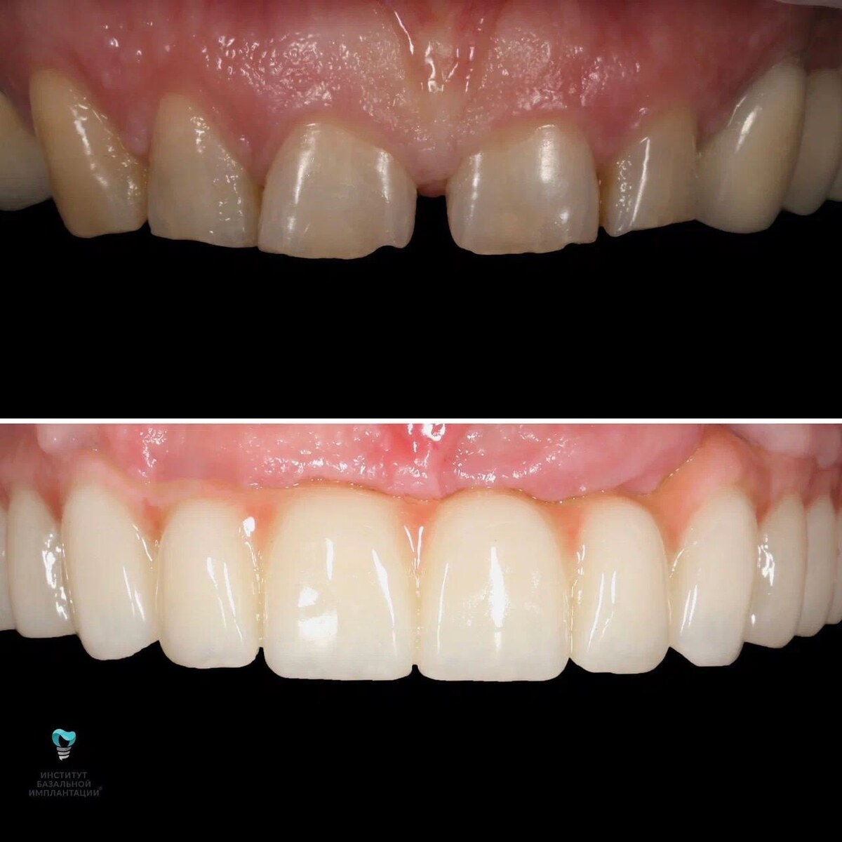 Базальная имплантация зубов | Кейс имплантации | Институт Базальной ...