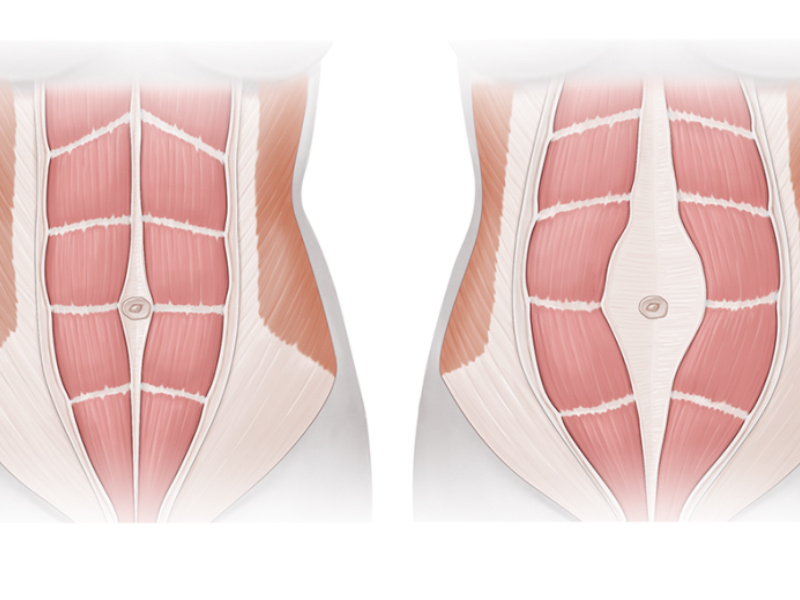 Диастаз - это расхождение прямых мышц живота, которое происходит, когда соединительная ткань, называемая белой линией живота, растягивается.