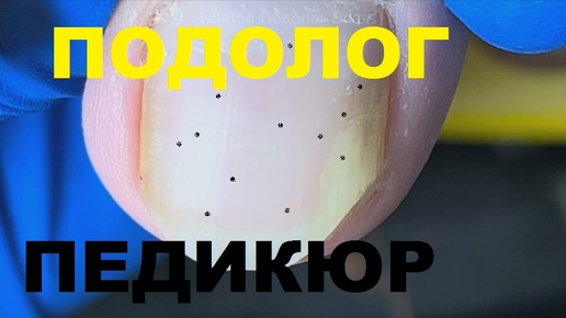 Онихогрифоз ногтей на ногах. #подолог #подологиявросшийноготь #онихогрифоз №5