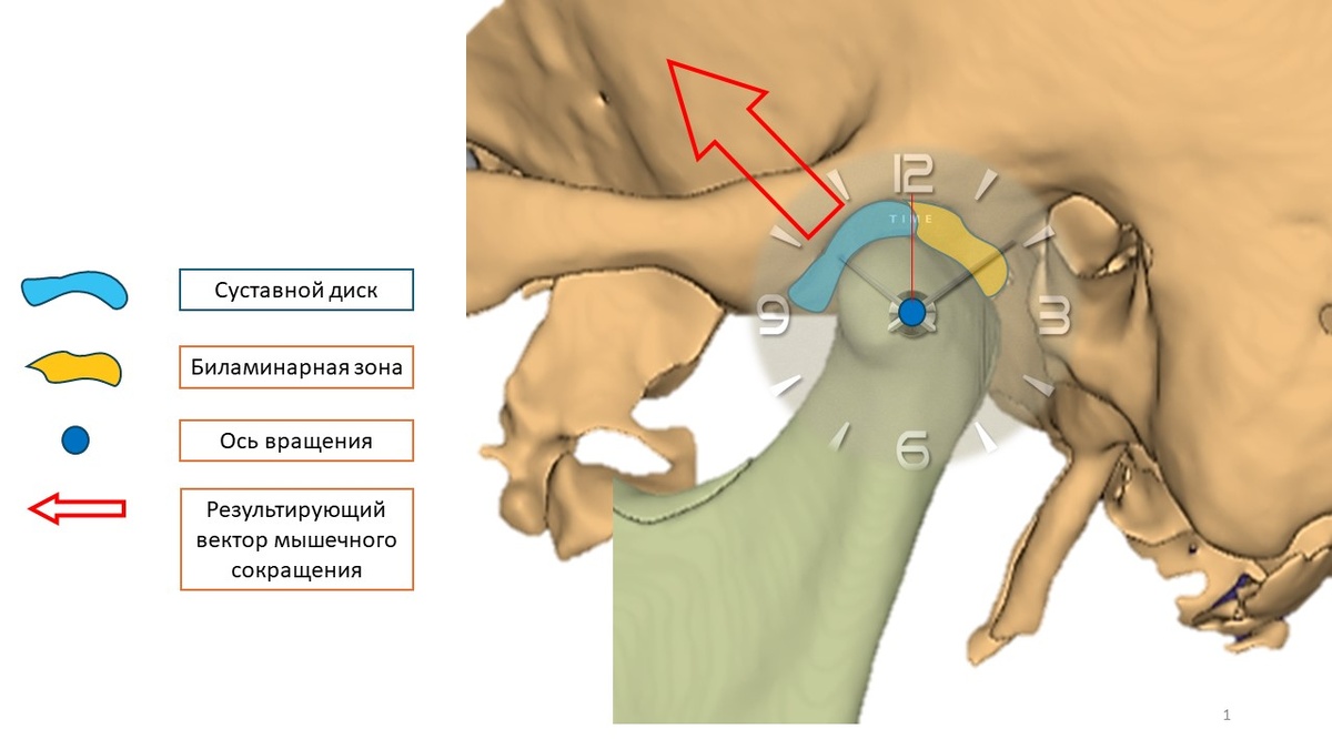 Здоровый нижнечелюстной сустав сбоку. Биламинарная зона - анатомическое образование с большим количеством сосудов и нервов, прикрепленная к суставному диску.