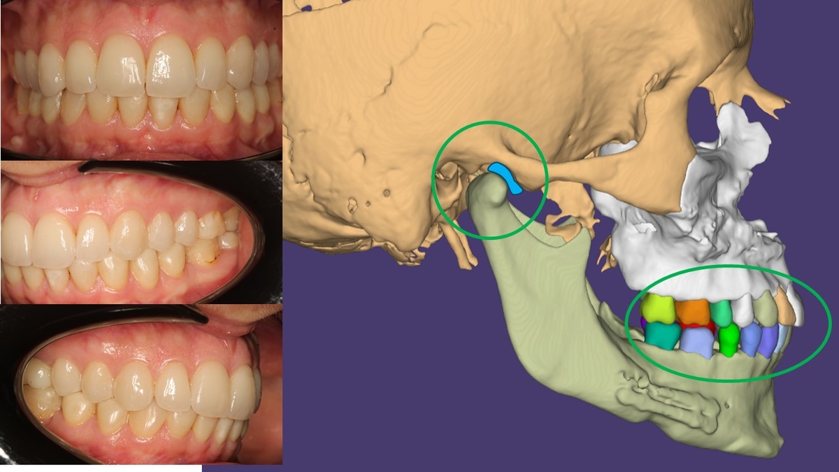 Поддержка здорового сустава правильным прикусом