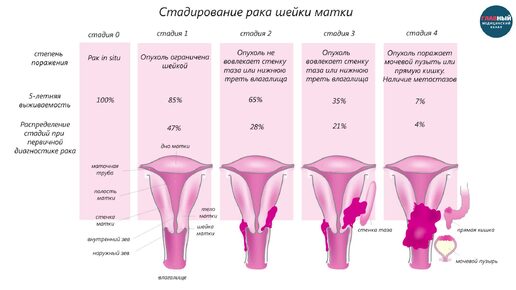 Симптомы РАКА шейки МАТКИ у женщин. Признаки и стадии как проявляется рак шейки матки