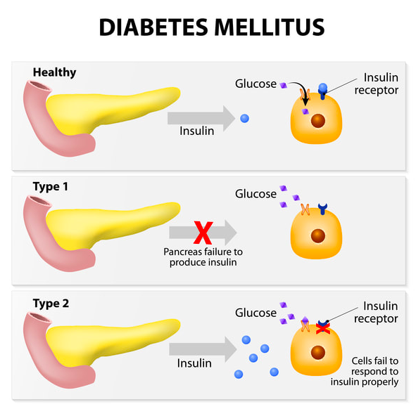 Типы диабета