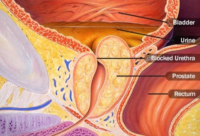 Блокировка мочеиспускательного канала