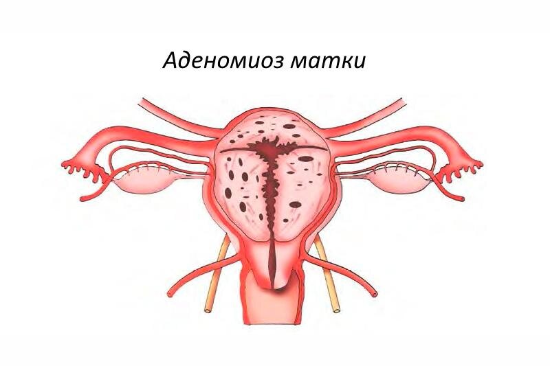 Аденомиоз — это заболевание, при котором происходит разрастание эндометриоидных клеток в миометрии (мышечном слое тела матки), а не в полости матки, как должно быть в норме.
