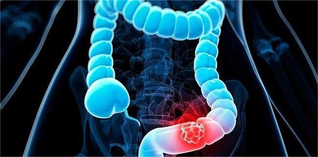 Частота заболеваемости колоректальным раком в ближайшие годы будет расти