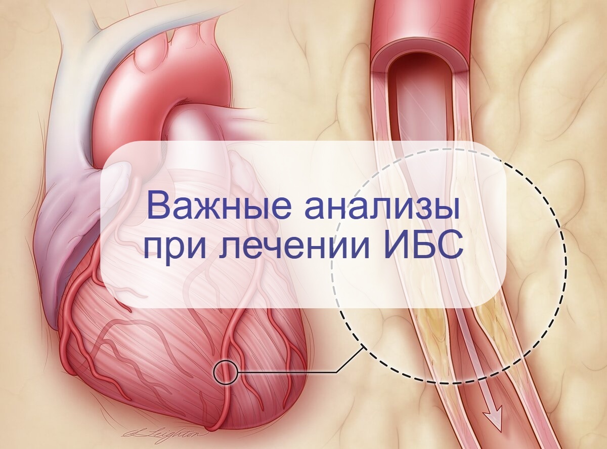 У вас ИБС? Вот какие анализы надо сдавать, чтобы контролировать болезнь | О  здоровье: с медицинского на русский | Дзен