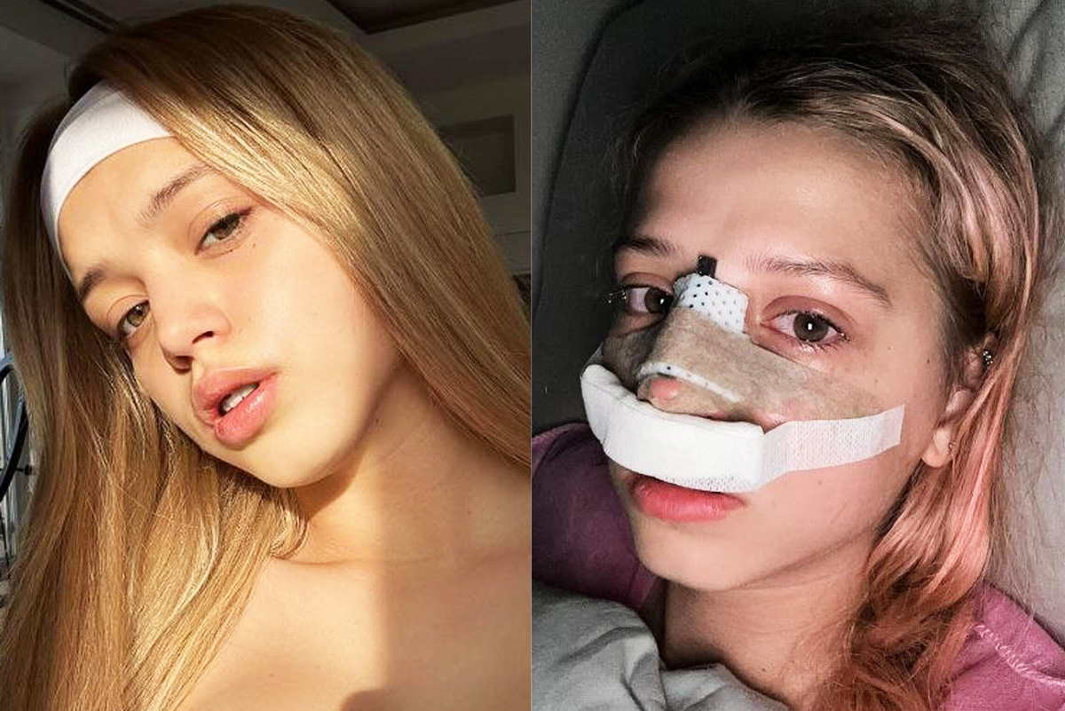     «Слезы идут без остановки»: Юлия Гаврилина показала лицо после пластической операции