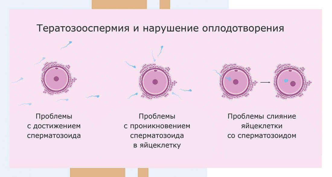 Проблемы с оплодотворением, вызываемые тератозооспермией
