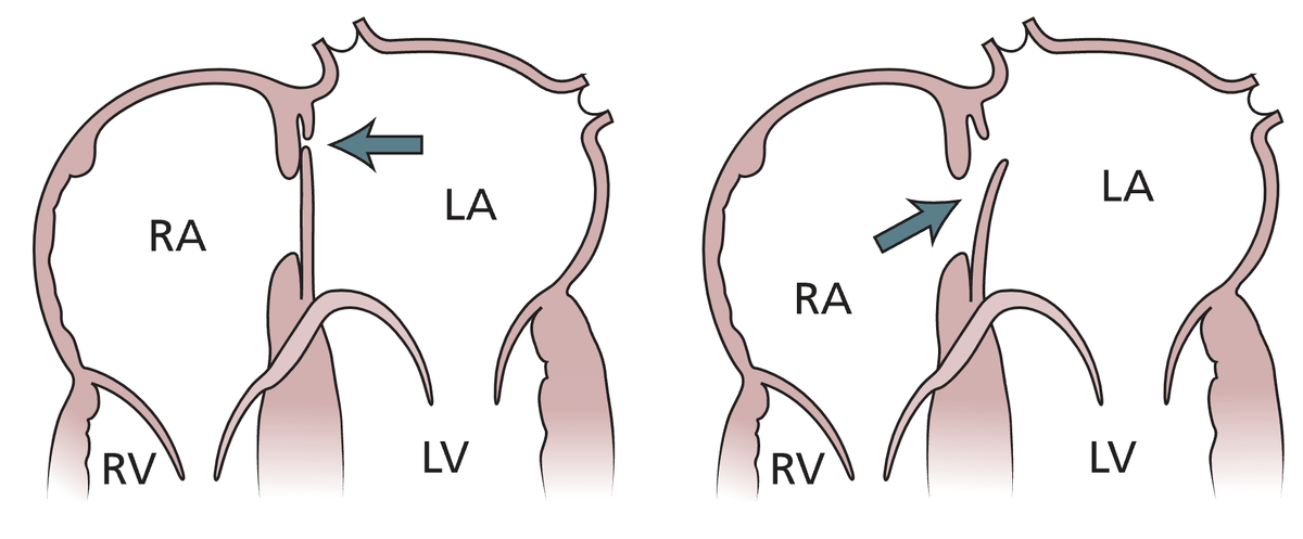 Открытое овальное окно. Стрелки показывают механизм сброса крови справа налево через открытое овальное окно. LA = левое предсердие; LV = левый желудочек; RA = правое предсердие; RV = правый желудочек.