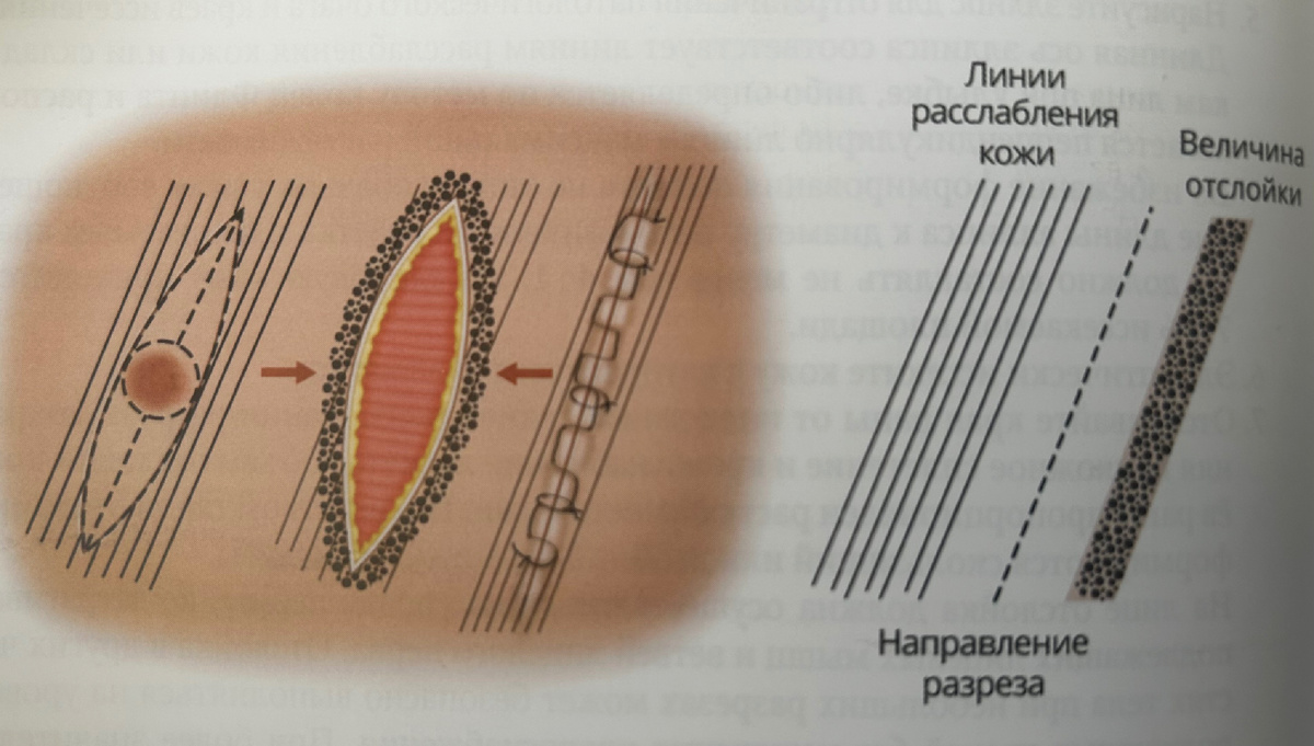 Линия разреза всегда проходит вдоль линий расслабления кожи. Это помогает правильно сопоставить края раны и не допустить перерастяжения краев раны.