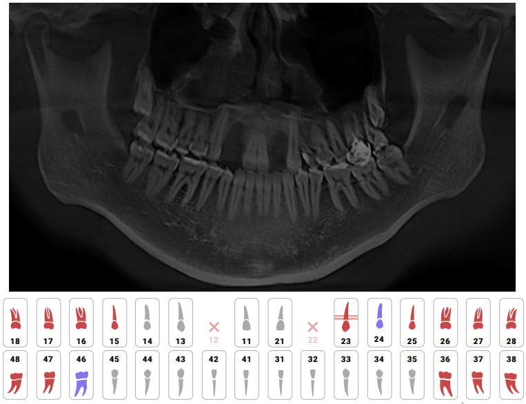 
Так выглядит общее заключение искусственного интеллекта о состоянии зубов