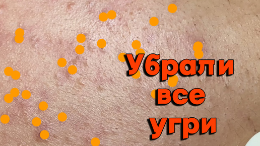 Все лицо в ЧЕРНЫХ ТОЧКАХ и угрях