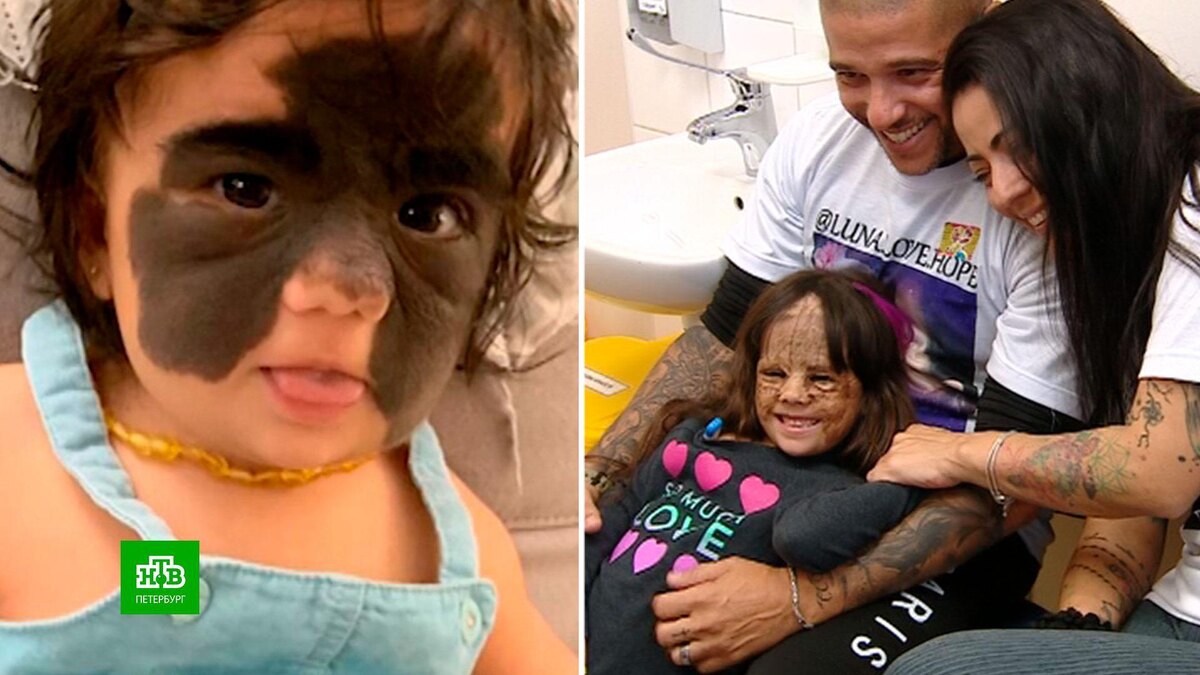    Американская девочка с «маской Бэтмена» успешно перенесла первую операцию в Петербурге