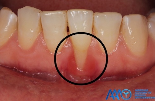 Рецессия десны