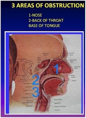 3 места обструкции верхних дыхательных путей