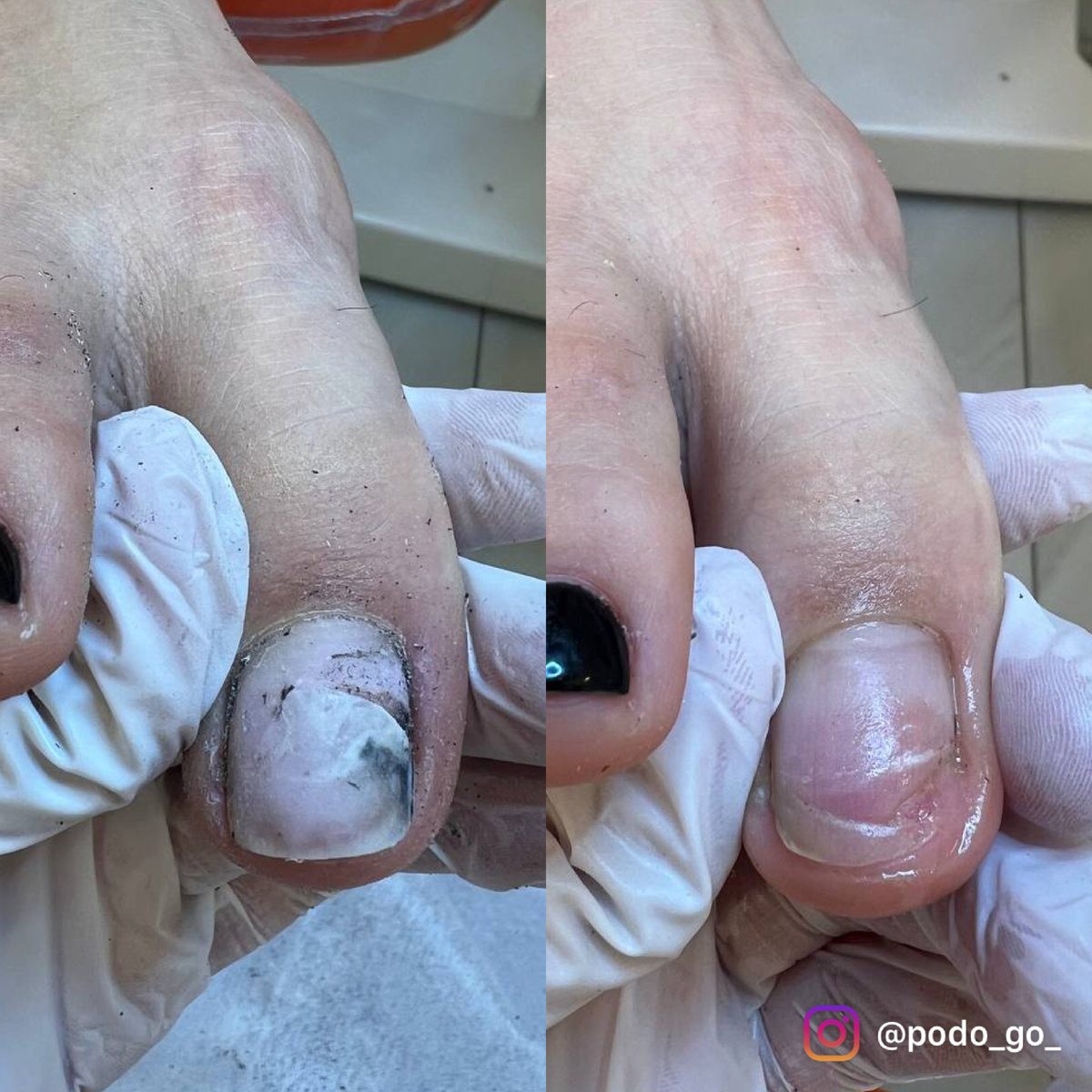 Обработка травмированного ногтя. Подолог Аиша Абакаровна