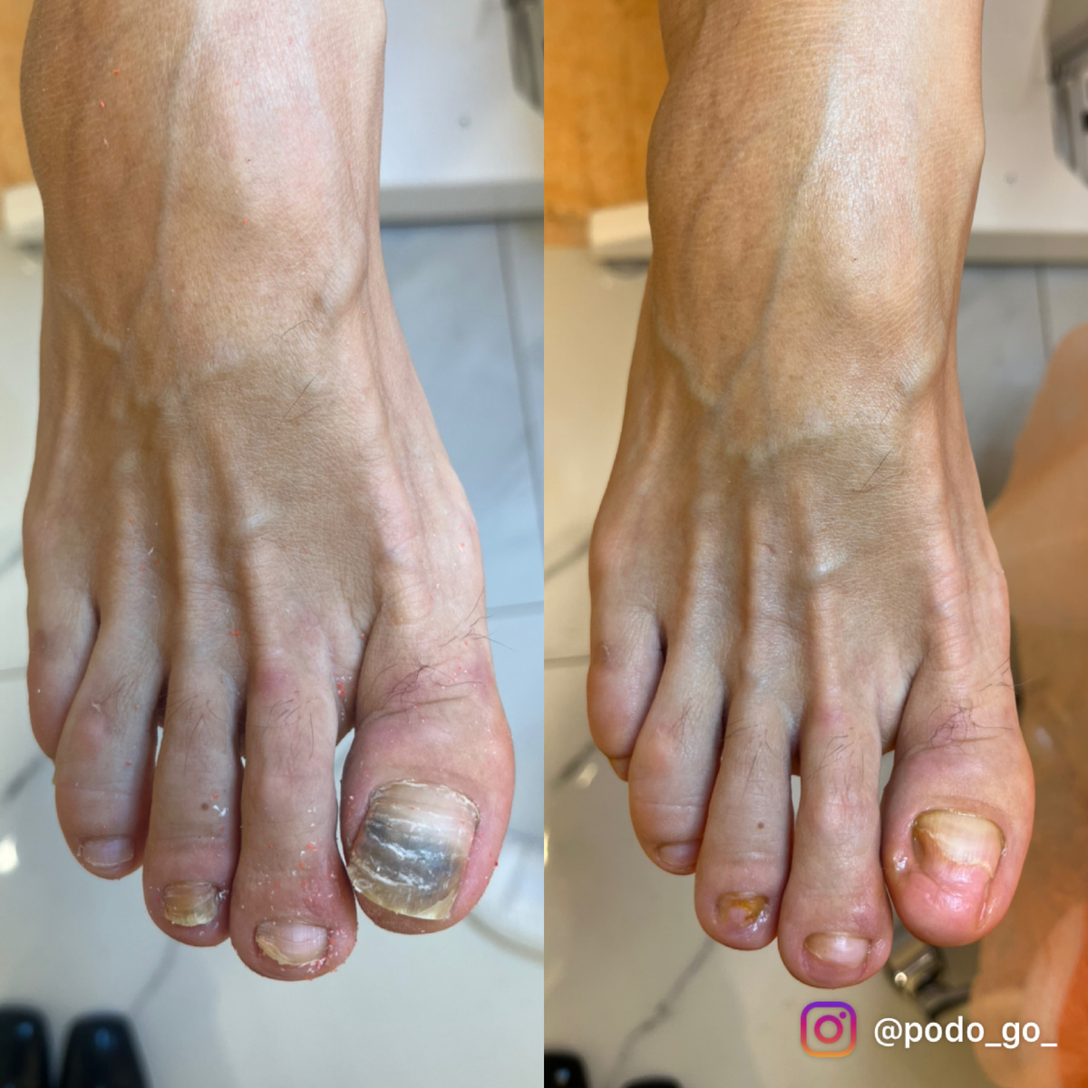 Обработка травмированного ногтя с гематомой. Подолог Анжела Анатольевна