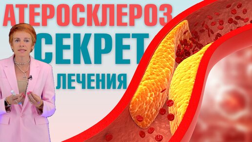 Как помочь себе при атеросклерозе? Атеросклероз - что это такое и как его лечить