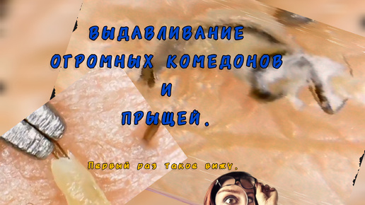 Таких ЖИРНЫХ И КРУПНЫХ УГРЕЙ И ПРЫЩЕЙ я ещё не видела. ЧЕРНЫЕ ТОЧКИ размером с монету.