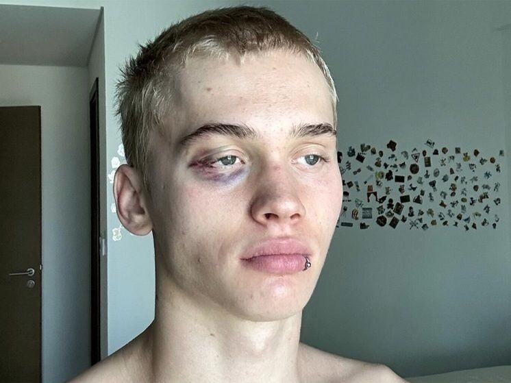    Даня Милохин с фингалом. Фото: @danya_milokhin