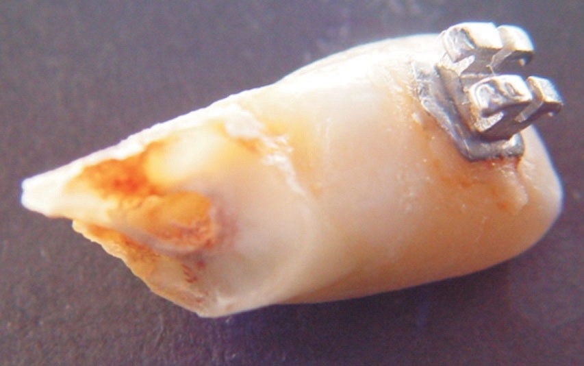 Резорбция корней зубов. Резорбция корней зубов – это утрата или растворение внутреннего дентина либо внешнего покрытия разветвлений.