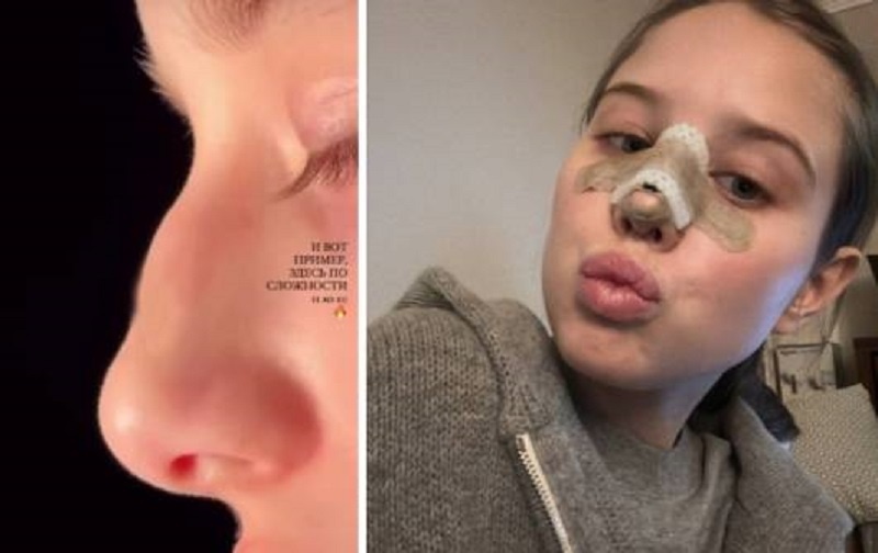 Аврора до и после операции