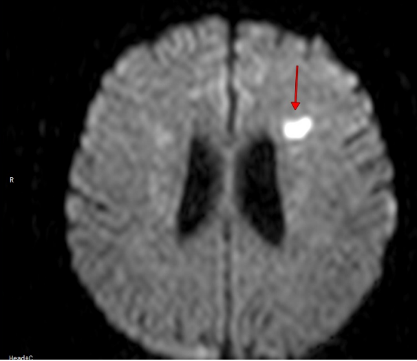 Дыра в моей голове. Остальные в другом полушарии. Повезло, что некрупная